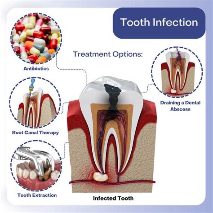 Can a doctor give you a prescription for a tooth infection?